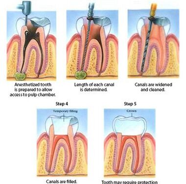 Exploring How Long Antibiotics Delay A Root Canal
