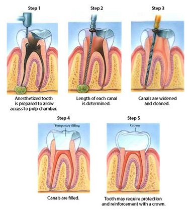 how-long-will-antibiotics-delay-a-root-canal_1753711561